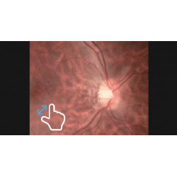 Rétinographe non-mydriatique portable sans fil haute résolution