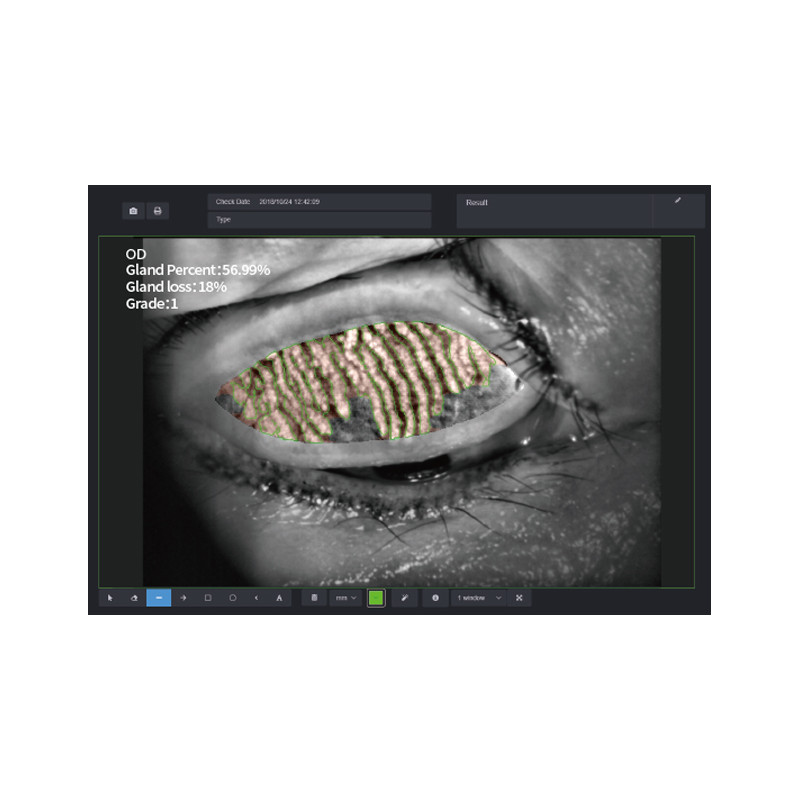 Examen de glande de Meibomius