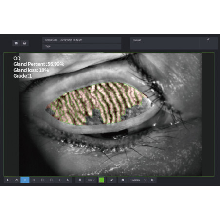 Examen de glande de Meibomius