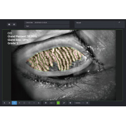 Examen de glande de Meibomius