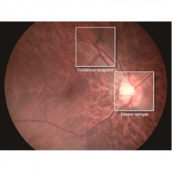 Rétinographe non-mydriatique portable sans fil haute résolution