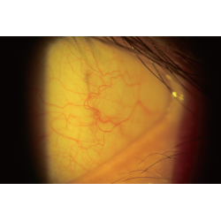 EXAMEN AVEC FILTRE JAUNE